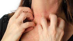 ¿Qué hacer en una crisis alérgica ?