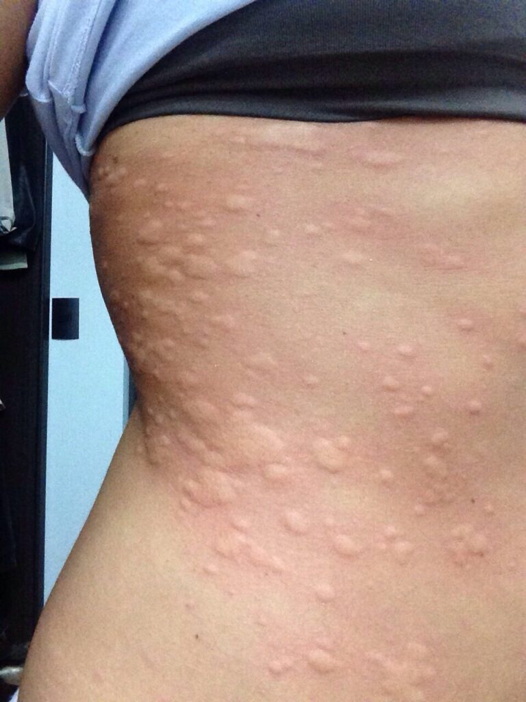 ¡Alerta en la piel! Todo lo que debes saber sobre la Urticaria